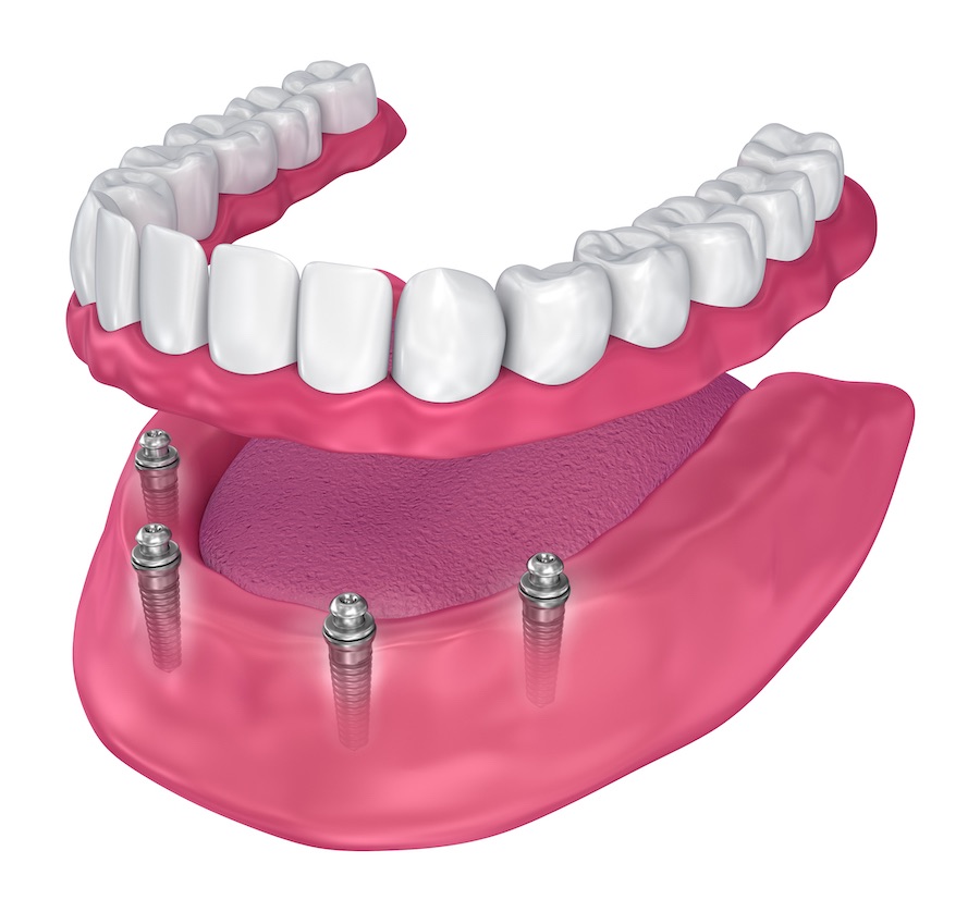 Mini implantátum - YES Dental