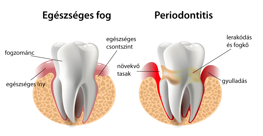 https://yesdental.hu/wp-content/uploads/2022/10/perionditis-1.png